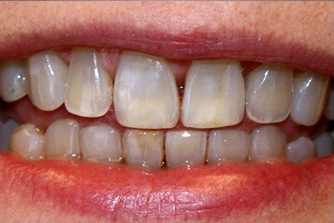Teeth Whitening in Lubbock, TX