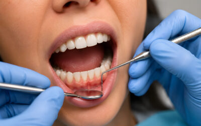 What a healthy dental cleaning looks like vs a standard general cleaning especially when gums are bleeding and what additional actions a hygienist can take beyond a standard cleaning
